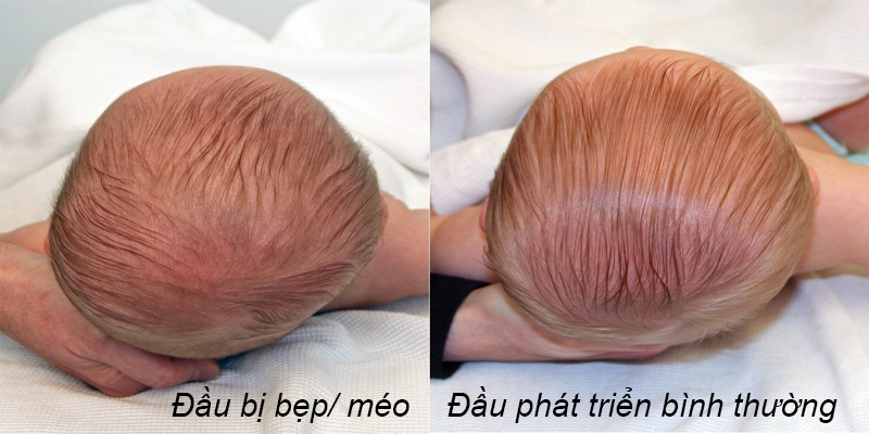 4 lưu ý vàng giúp ngăn ngừa và khắc phục tình trạng méo đầu ở trẻ sơ sinh