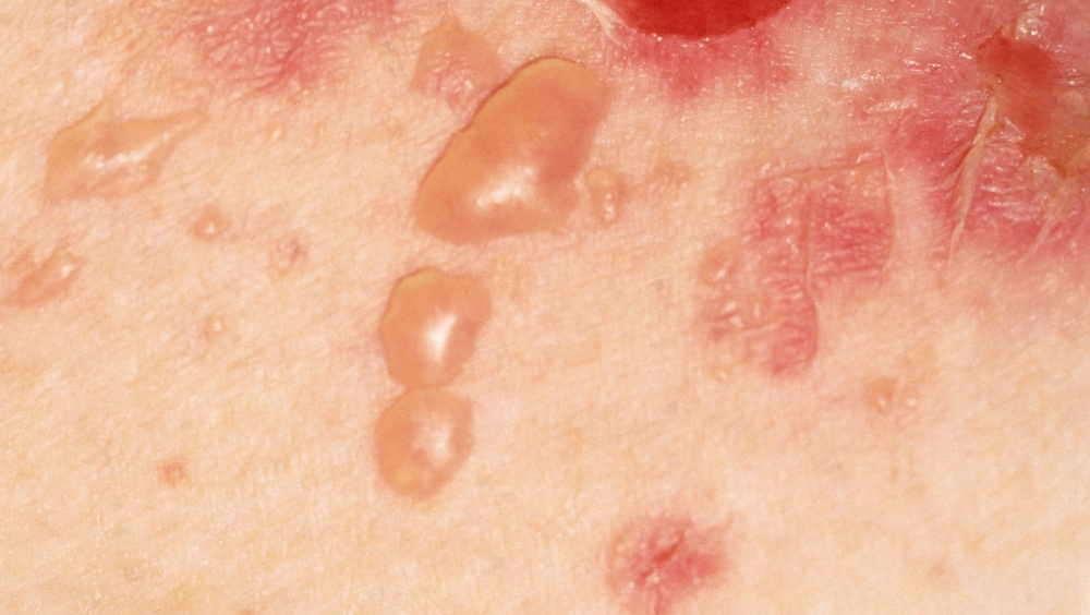 Pemphigus vulgaris là bệnh nguy hiểm như thế nào?